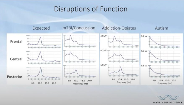 Disruption of brain function visualization at TMS of Westchester